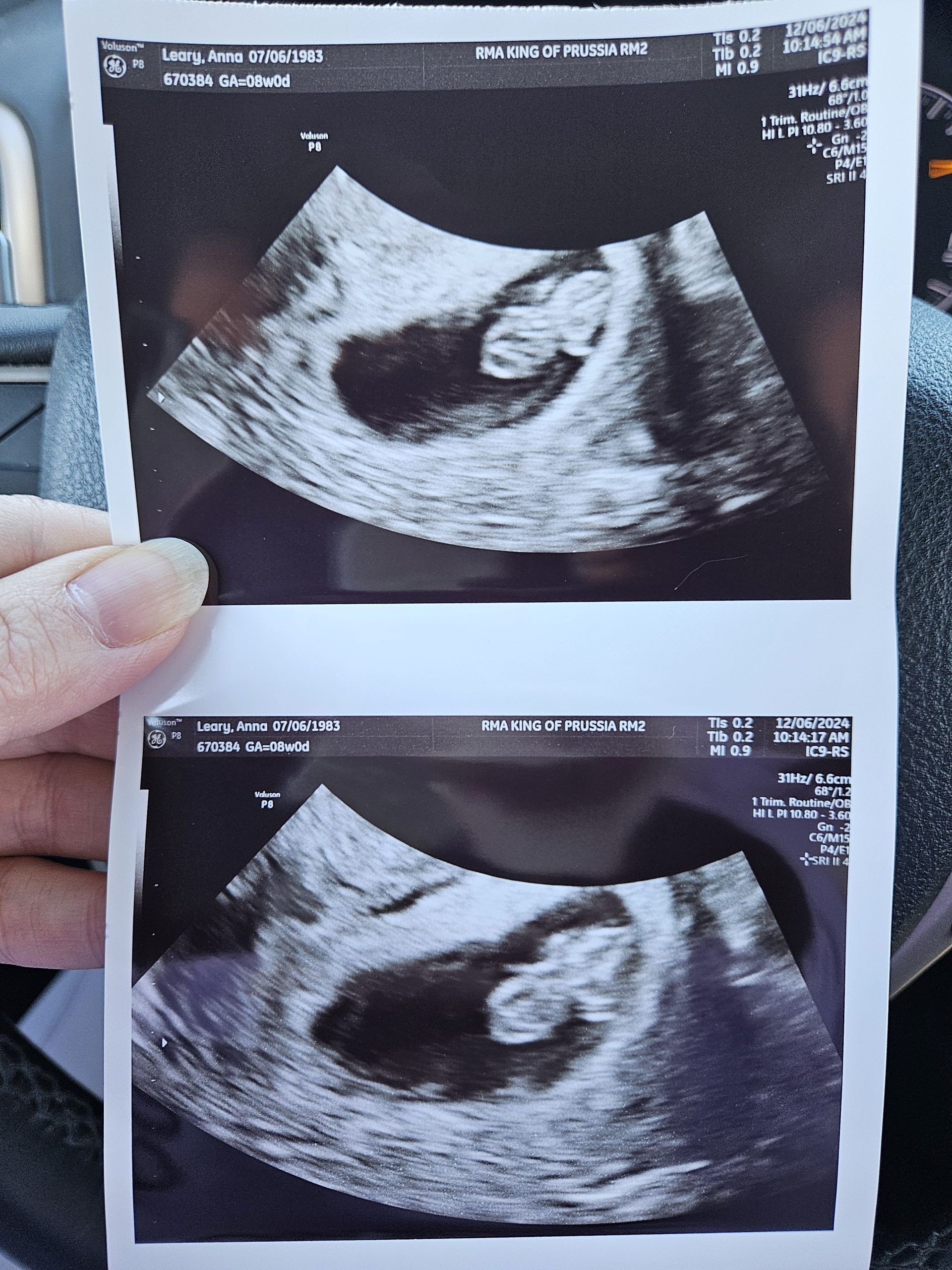 Photo of stacked ultrasound images at 8 weeks