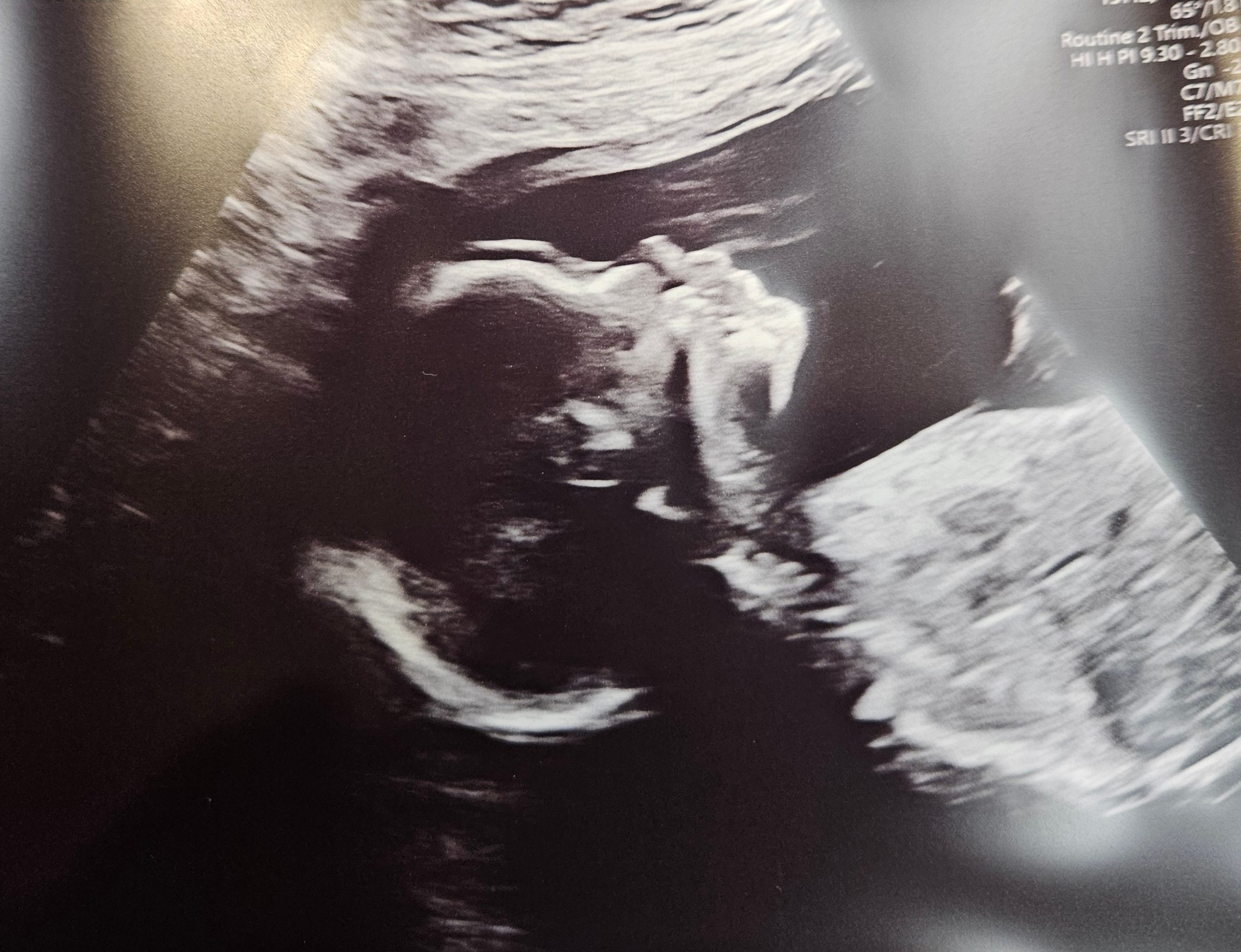 Photo of baby's head in ultrasound