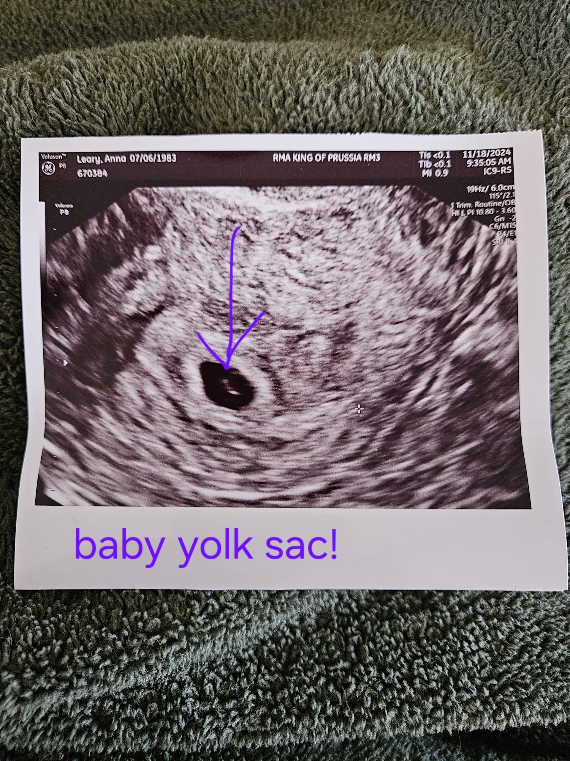 Photo of ultrasound pointing to a small baby yolk sac.